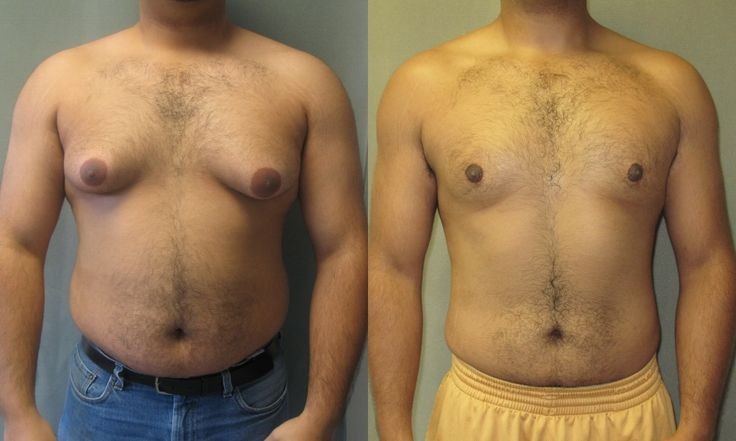 Gynecomastia – Causes, Treatment & Cost | Gynecomastia vs Chest Fat