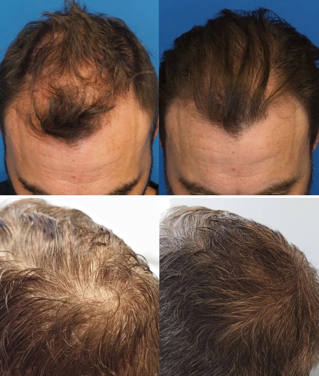 PRP vs PRF: Benefits, Procedure, Cost, Results & PRF EZGEL for Skin and Hair Rejuvenation