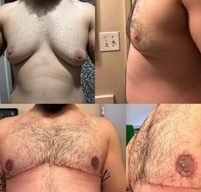 Gynecomastia – Causes, Treatment & Cost | Gynecomastia vs Chest Fat