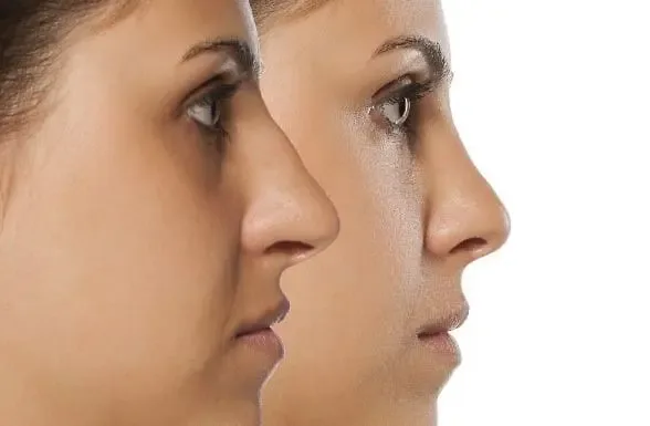 Rhinoplasty surgery and nasal reshaping at Le Pearl Aesthetics, Multan