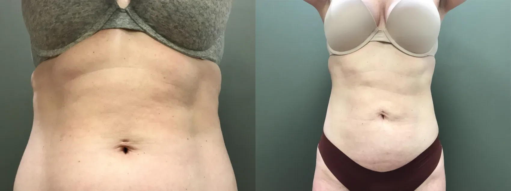 Marked liposuction treatment areas including abdomen and thigh before surgery
