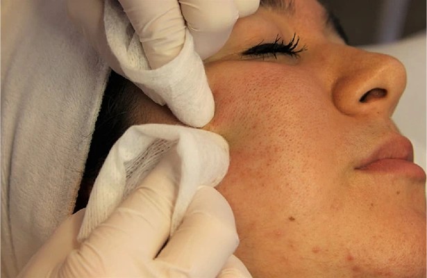 Acne Treatment in Multan treatment at Le Pearl Aesthetic Clinic