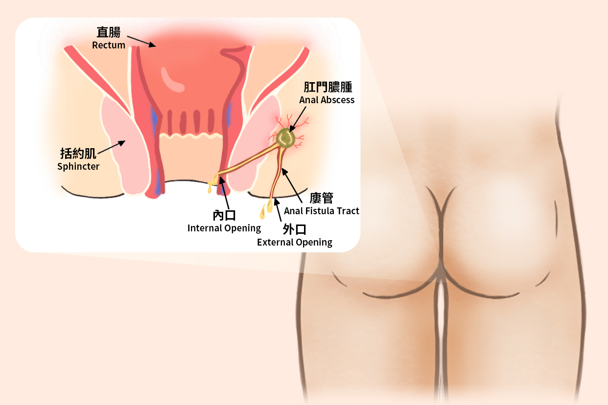 Anal Fistula Treatment in Multan: Mapping, Surgery and Recovery treatment at Le Pearl Aesthetic Clinic