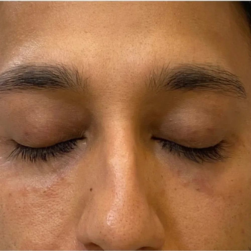 Before Eye Filler Treatment for Hollow Eyes