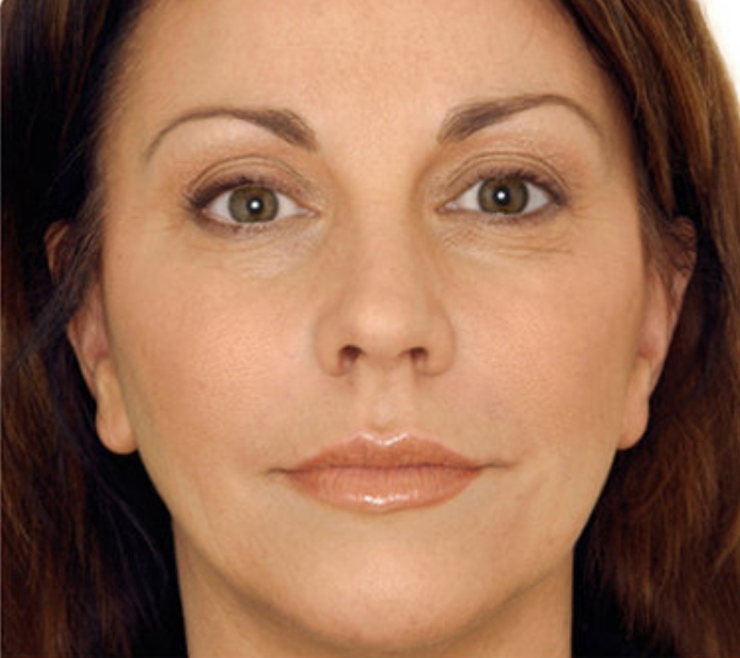 After PRF Skin Treatment