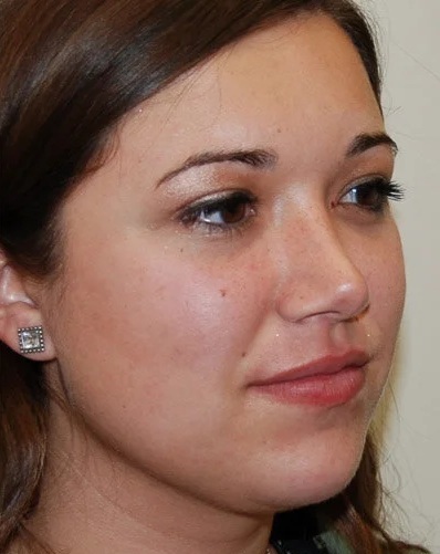 After Double Chin Treatment