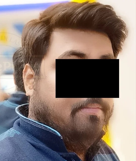 After Beard Treatment