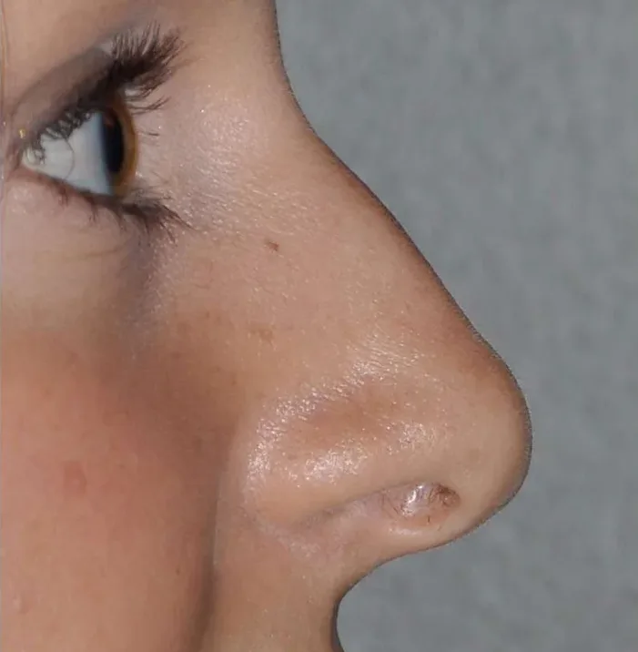 Rhinoplasty in Multan before treatment