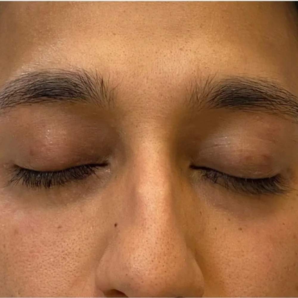 After Eye Filler Treatment for Hollow Eyes