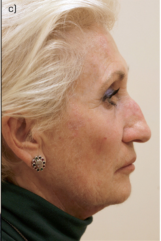 Before PRGF Skin Treatment