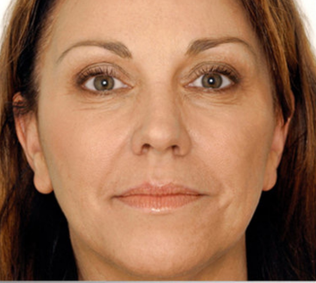Before PRF Skin Treatment