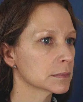 Before Cosmetic Surgery
