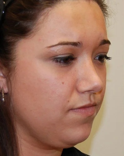 Before Double Chin Treatment