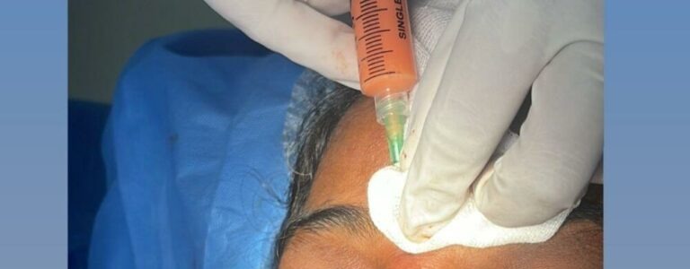 Fat Grafting in Multan: Face, Hands, Scars, Breast, Penis treatment at Le Pearl Aesthetic Clinic