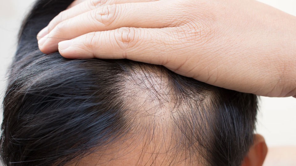 Alopecia Treatment in Multan treatment at Le Pearl Aesthetic Clinic